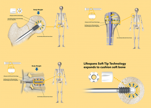 Lifespans develops three implants for repairing fractures in the elderly: the Lifespans Soft Hip, Soft Shoulder, and Soft Spine.